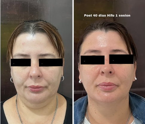 Antes y después tratamiento HIFU en Adrogué