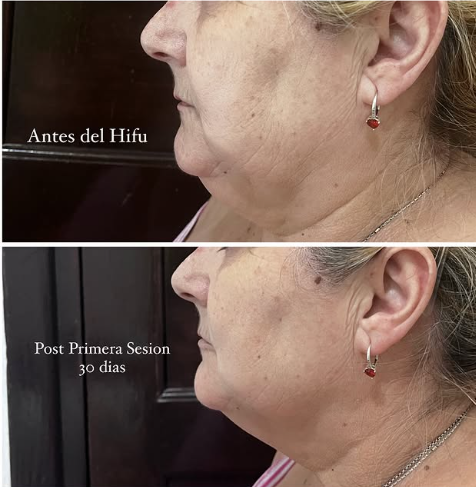 Antes y después tratamiento HIFU en Adrogué