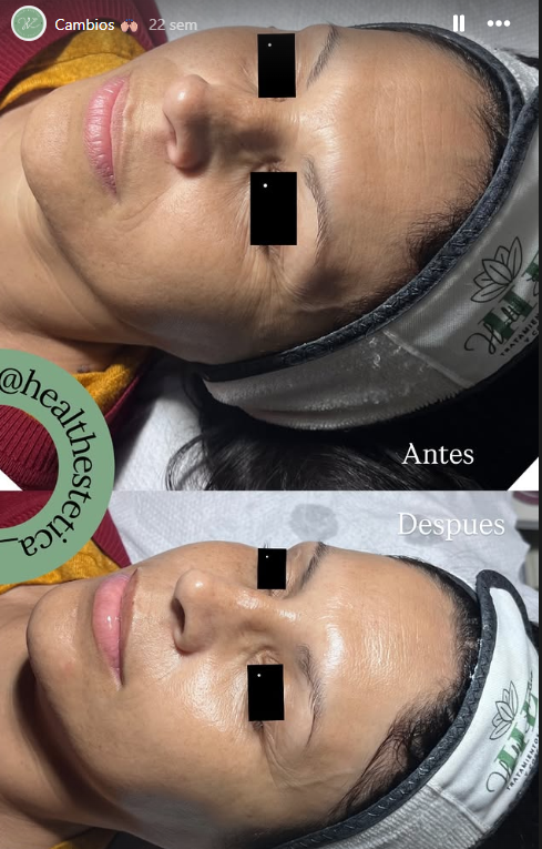 Antes y después tratamiento HIFU en Adrogué