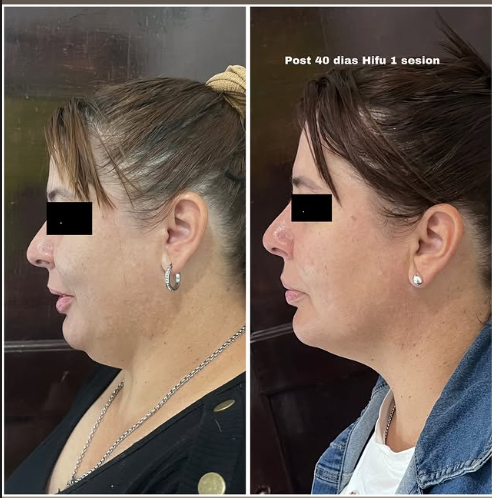 Antes y después tratamiento HIFU en Adrogué